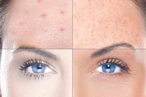 ΦΡΟΝΤΙΔΑ ΔΕΡΜΑΤΟΣ / ΤΡΙΧΟΠΤΩΣΗ